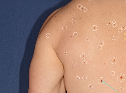 AI-Assisted Skin Checks