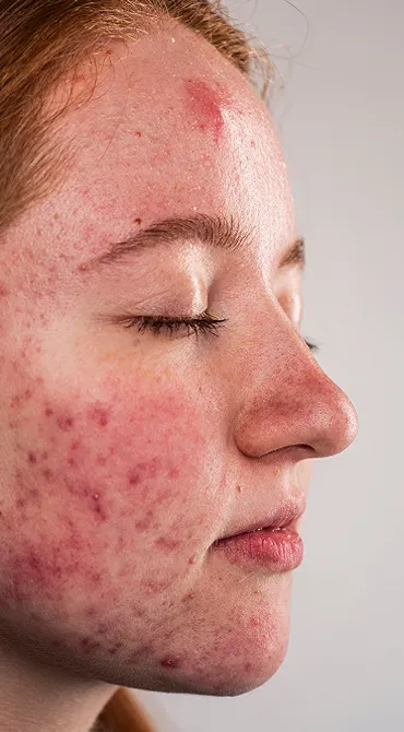 Specialist Acne  Clinic